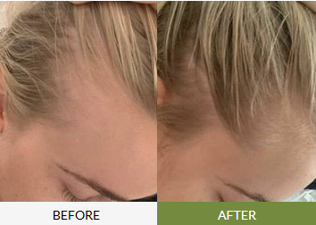 Before and after hairline improvement with visible regrowth and thicker front hair