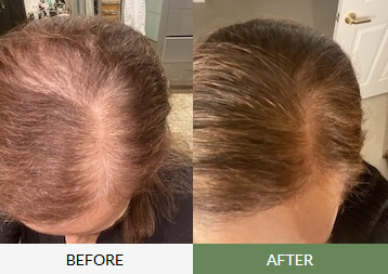 Hair thinning before and after comparison showing reduced scalp visibility and fuller hair growth