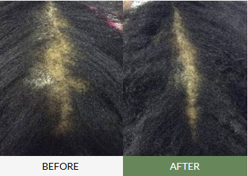 Before and after results of hair thinning treatment showing improved hair density on crown area